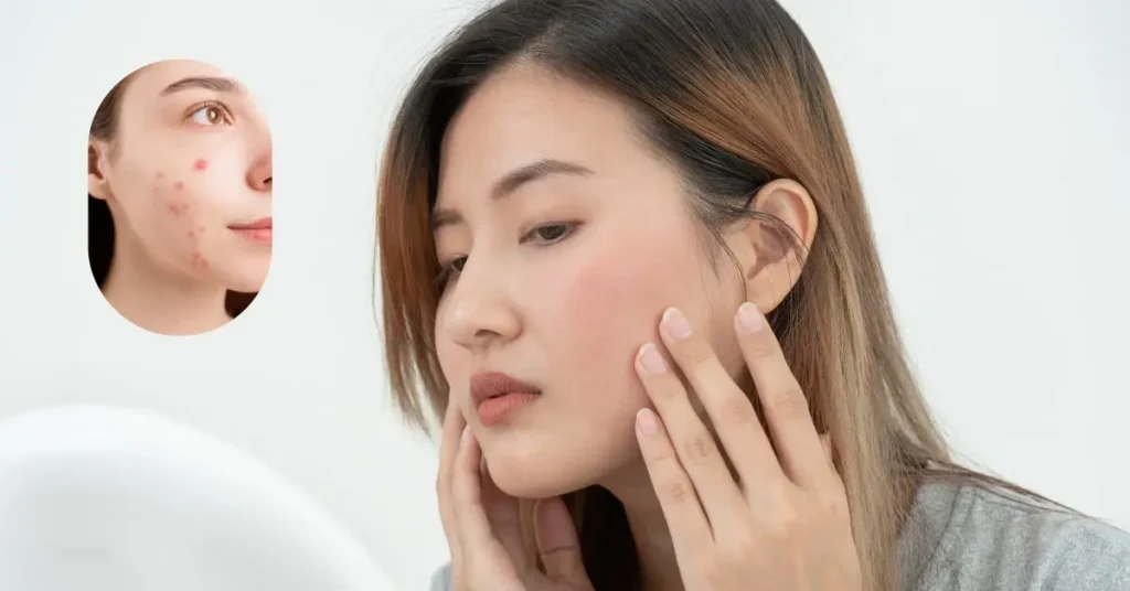 Infection due to face fat grafting.
